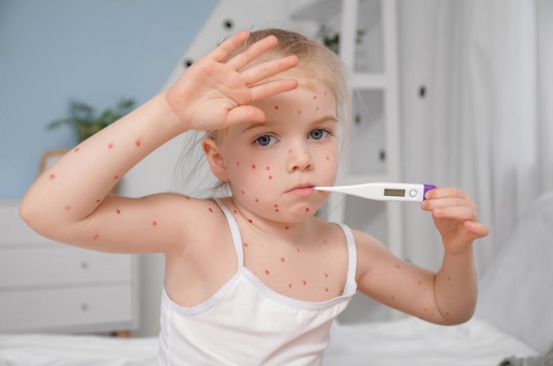 Jak poznat neštovice první den: Průvodce pro vyděšené rodiče